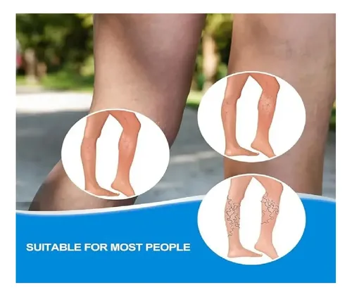 Crema Para Alivio De Varices Piernas Varicosas