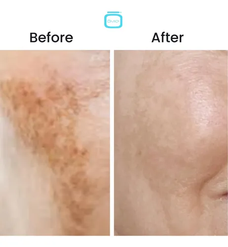 10% Tranexamic Acid Cream  1 Fl Oz / 30ml  Skin