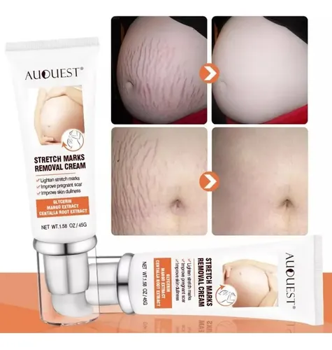 Crema Estrias Embarazada Maternidad Tratamiento Piel Seca
