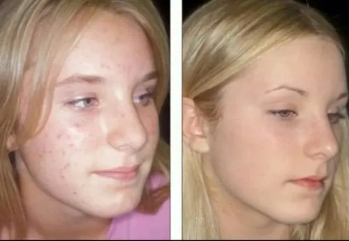SEBUM CONTROL TREATMENT Idraet Dermopurity