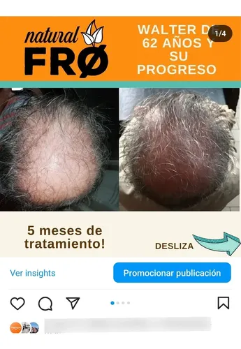 Loción Capilar Caida-crecimiento Capilar Naturalfro X 100ml