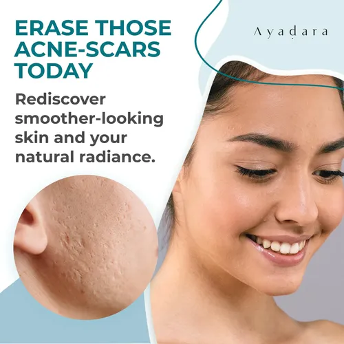 Crema Cicatrices Acné Ayadara Humectante Rostro Cuerpo