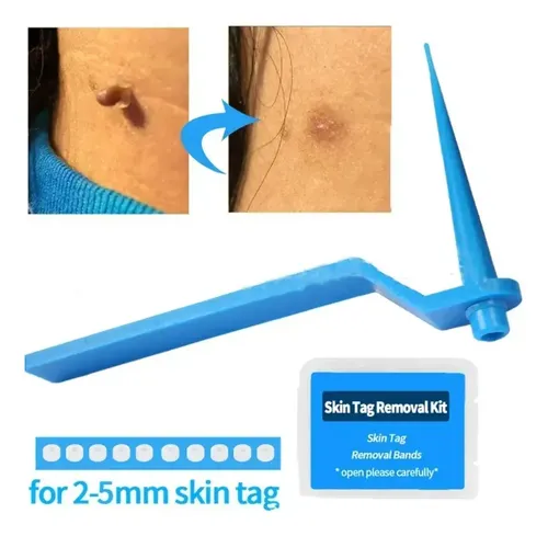 1 Set De Removedor De Verrugas Mole Tag Ii