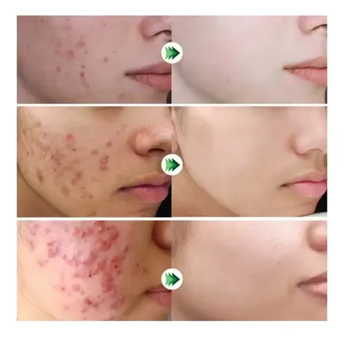 Crema Tratamiento Acne Granitos 100% Efectividad Todo Tipo De Piel Día/noche
