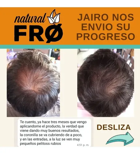 Loción Capilar Naturalfro Crecimiento Calvicie Caida X 400ml
