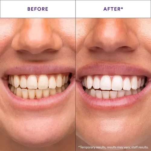 Tiras Blanqueadoras Dentales Limpieza Profunda