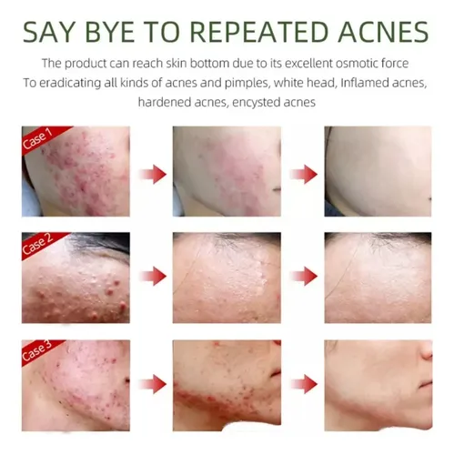 Ai Crema Facial Antiacné, Elimina Profesionalmente Las