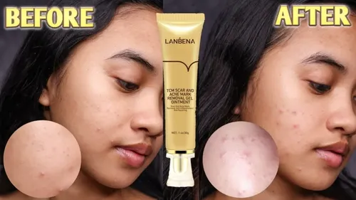 Gel Crema Cicatrices Manchas Estrias Acne -no Cicatricure