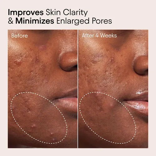 Tónico Líquido Alpyn Pore Perfecting Con 2% Bha Y Borraja 12