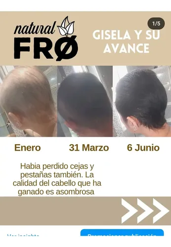 Locion Capilar Naturalfro Caida X 100ml + Shampoo Solido Kit