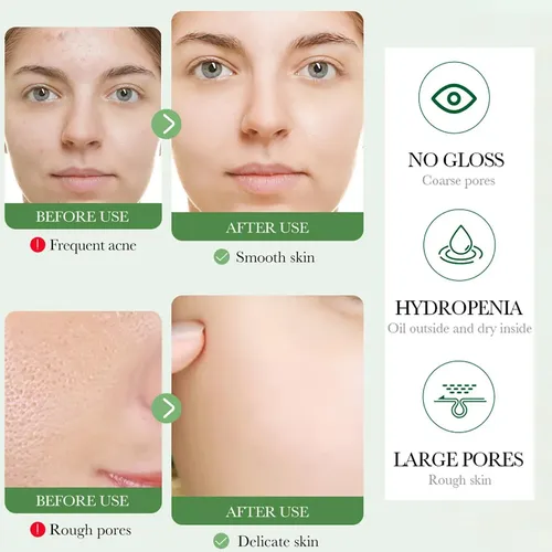 Gel Facial Espumoso Limpiador Centella Asiatica Anti Acne