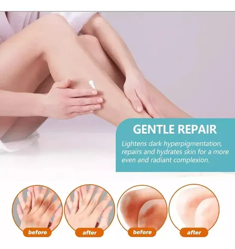 D Fixderma Nigrifix Crema Para Acantosis Nigricans Fbgxx