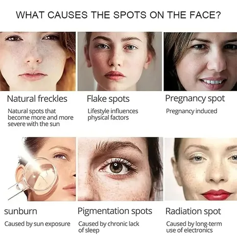 Crema Para Manchas Oscuras En La Cara, Cremas Para Quitar