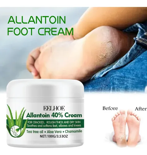 La Crema Para El Cuidado De Los Pies Eelhoe Hidrata Y Cuida