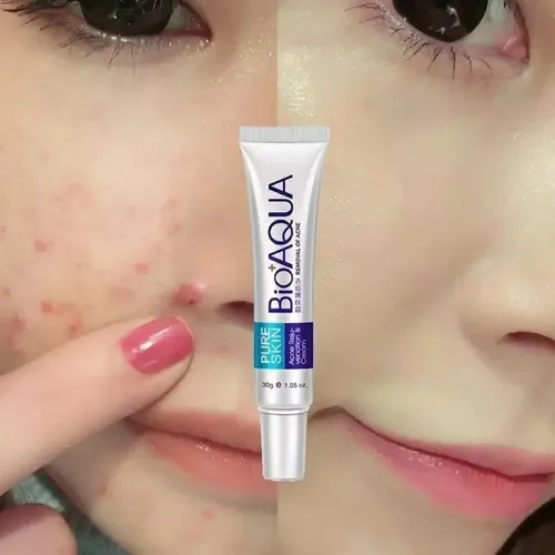 Gel Anti Acne Descongestivo Suavizante Poros Cerrados Lanben