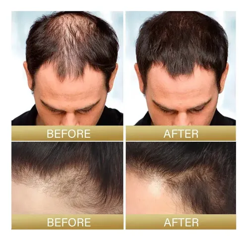 Esencia Para El Crecimiento Del Cabello Xinnuo Oil 111