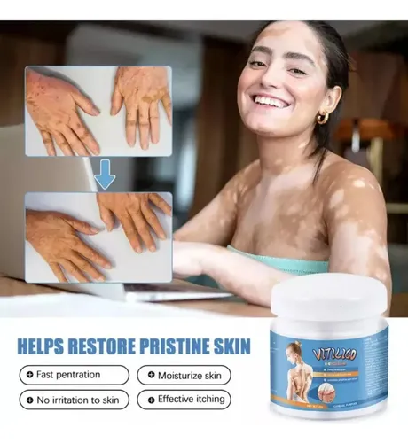 / Xpara Crema Para Vitíligo, Elimina Las Manchas Blancas.