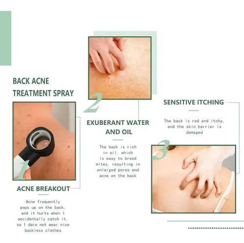 2×cura El Acné Espalda Con Ácido Salicílico Aceite Árb .