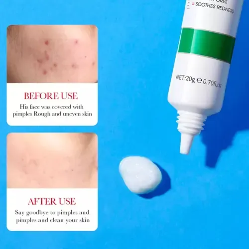 Crema De Ácido Salicílico Para El Control Del Acné Para Piel