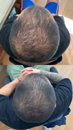 Loción Anticaida 5%, Fortalece, Crece Y Nutre El Cabello