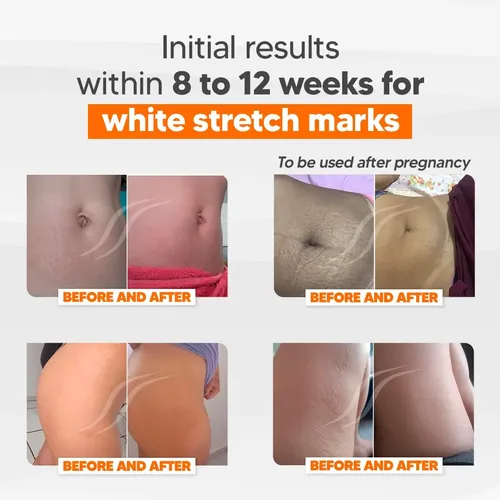 Crema Cicatrissim 150 Ml Estrías Profundas Y Elasticidad