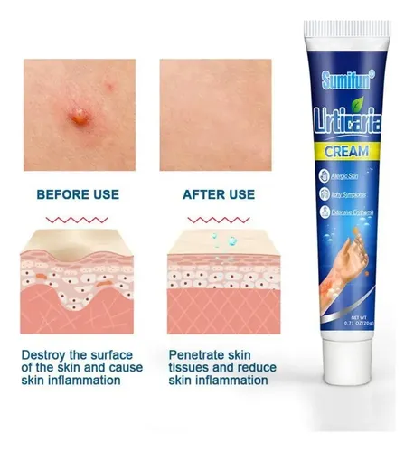 Qa/crema Antipruriginosa For Urticaria, 20 G, Antiherbales .