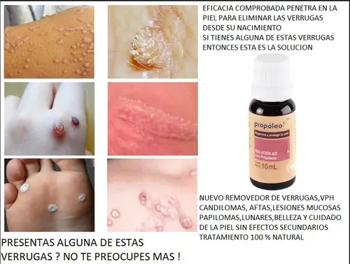 Crema para Eliminar Verrugas del Cuerpo con Propóleo y Fórmula Natural de 10 mL