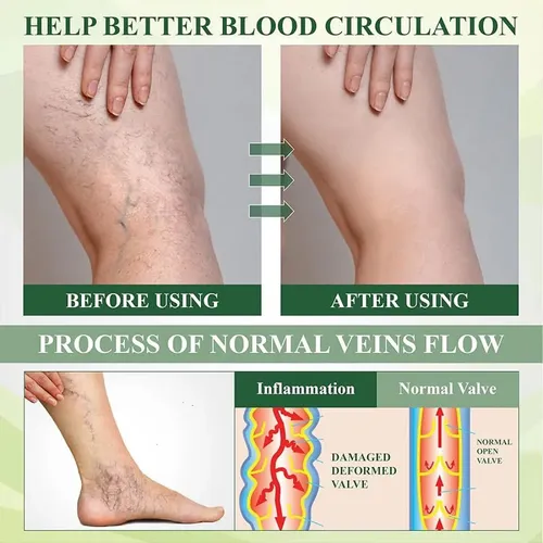 Crema Para El Cuidado De Las Piernas Para El Edema, Crema Pa