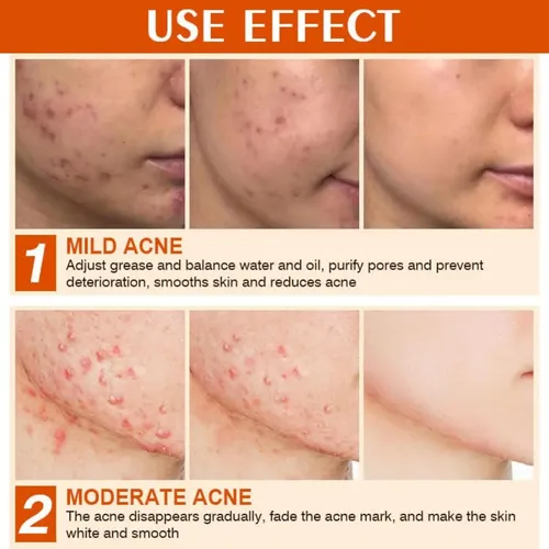 Z. Crema De Acné Crema De Espinillas Para La Cara,