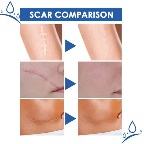 2×crema Para Eliminar Cicatrices Más Rápida Y Moderna, Gel