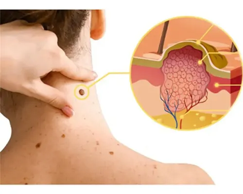 Crema Antipigmentaria Para Eliminar Las Verrugas Del Herpes,