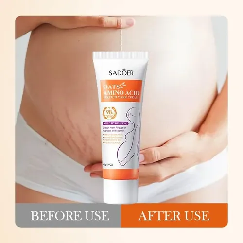 Crema Corporal Suave Reduce Estrías, Mejora Elasticidad