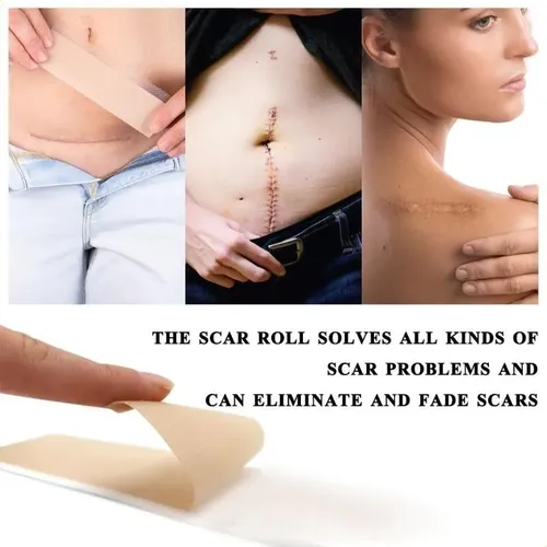 Rollo De Gel De Silicona Scar Patch De 150 Cm Para Terapia D