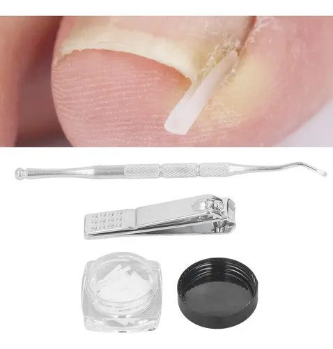 Mokasi Kit De Eliminación De Uñas Encarnadas, 50 Pcs