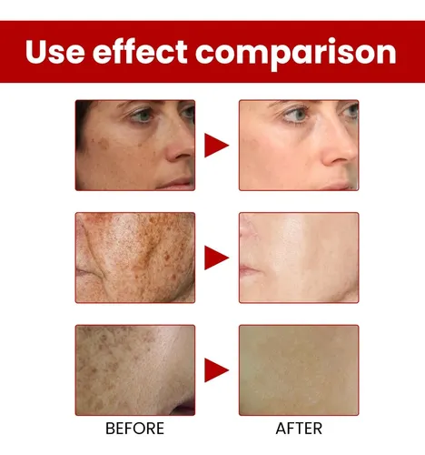 Crema Facial Hidratante For Manchas De Pigmento Aclarante