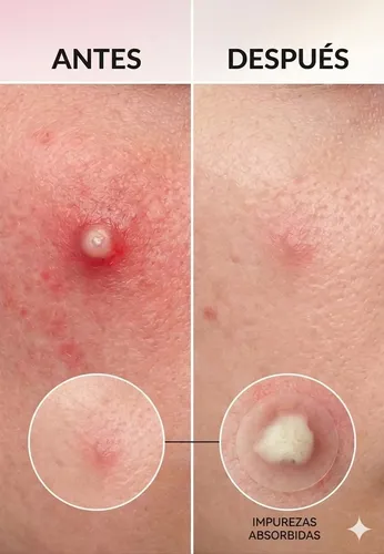 36 Parches Antiacné Invisibles Y Resistente Al Maquillaje