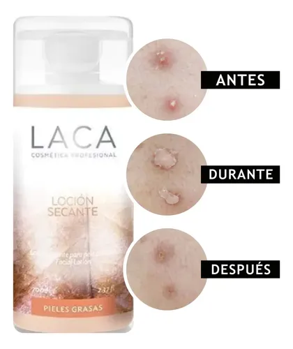 Loción Secante Laca Pieles Grasas Momento de aplicación Día/Noche Tipo de piel Grasa