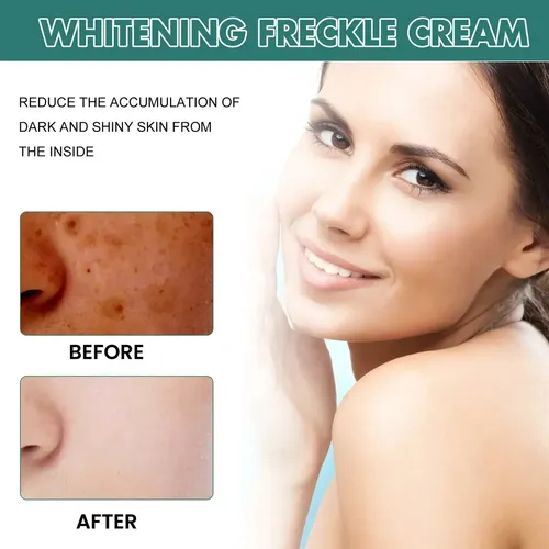 I Crema Iluminadora Facial Eelhoe Manchas Melasma Manchas Y