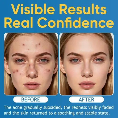 2pcs Acne & Redness Killer, Organics Acne Balm, Remove Skin
