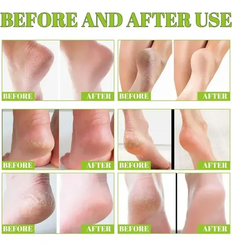 Crema Exfoliante De Urea For Eliminar Los Callos De La Piel