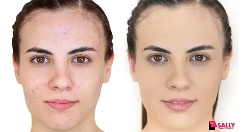 Sebum Control Tratamiento P/ Piel Grasa Elimina Sebo Y Acne