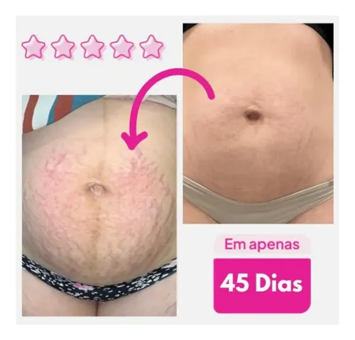 A/ Adeus Tratamiento Intensivo For La Piel Anticelulítico Yc