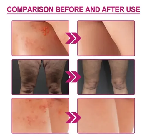 Crema For El Acné, Limpieza De Manchas Oscuras, Espinillas –