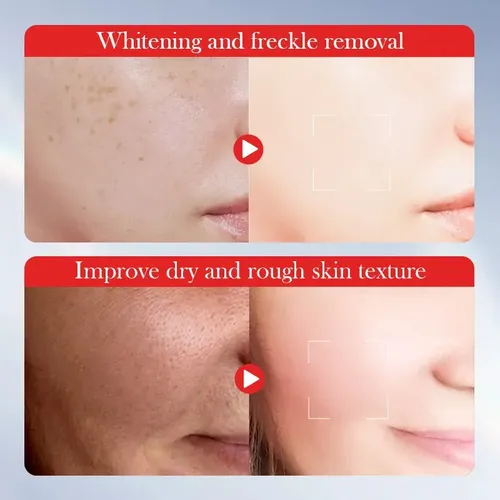 Crema Blanqueadora De Melanina Con Ácido Kójico Que Elimina