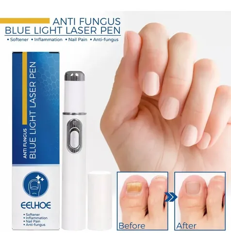 2×pluma Hongos Uñas Calientes Pluma Láser Luz Azul