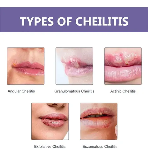 Tn 3 Parches Útiles For Aliviar El Herpes Labial Y Curar