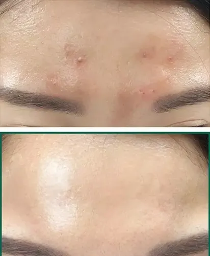 Crema Facial Antiacné Y Control De Aceite De Té Verde, 40 G