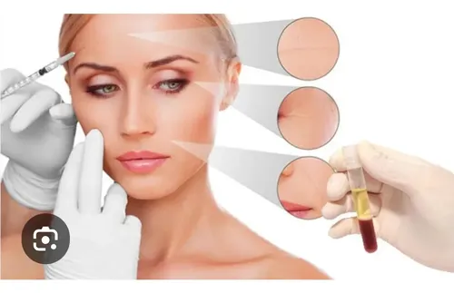 Plasma Rico En Plaquetas! Facial!!!!