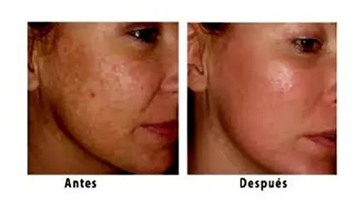 Acido Glicolico 50% Y Neutraizante 30cc Manchas Arrugas Caba