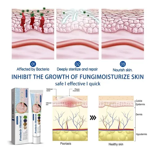 Crema Antimicótica Para La Tiña Inguinal
